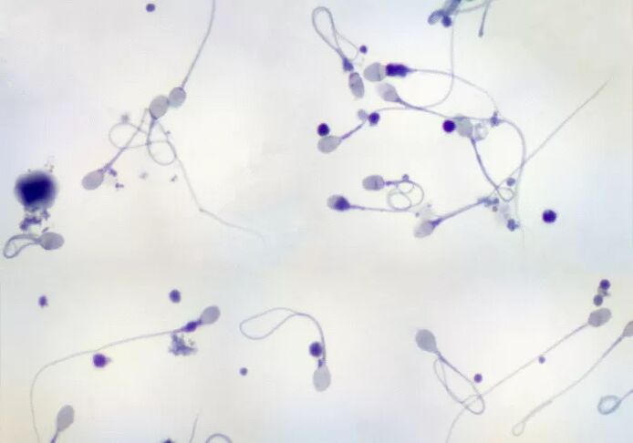 Diagnosed with oligozoospermia - few sperm